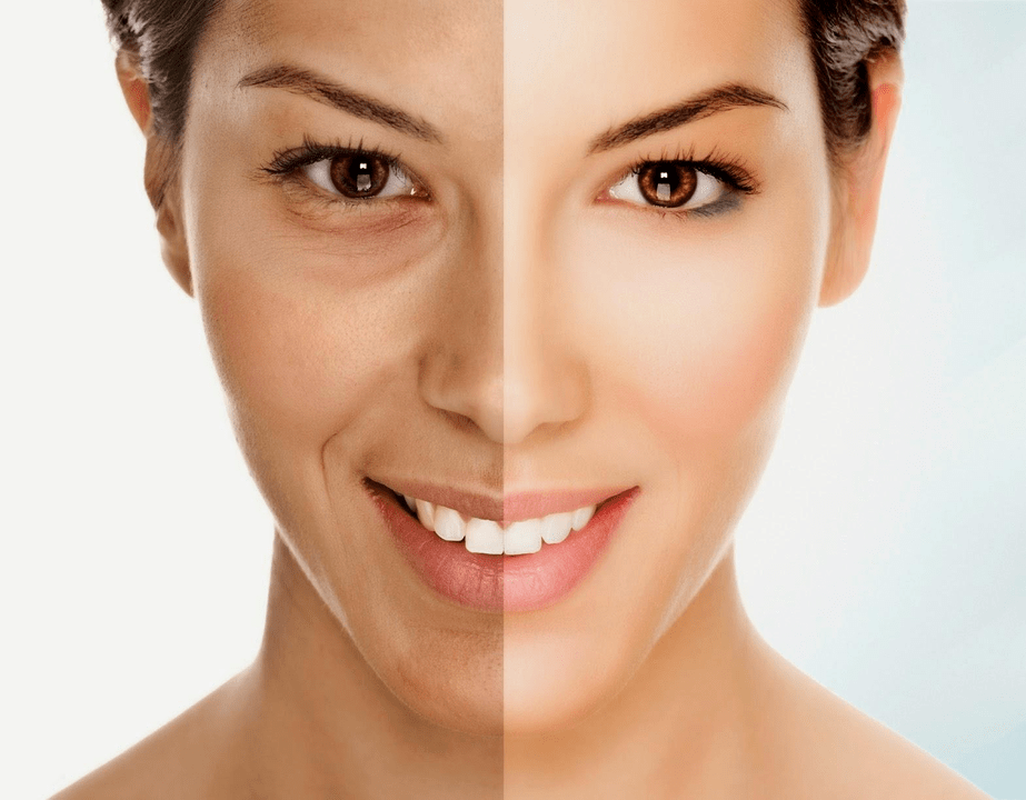 Intenskin for facial rejuvenation