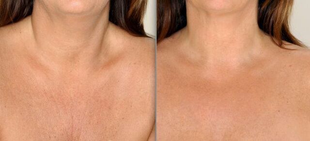 before and after fractional skin rejuvenation photo 2