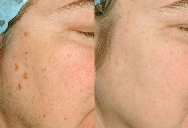 Remove pigmentation on the skin