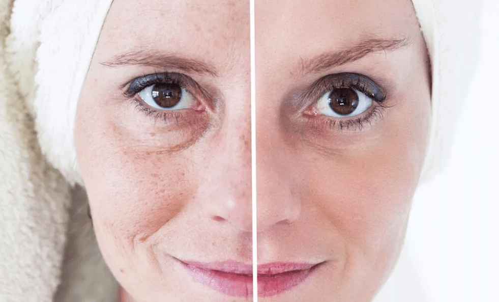 Laser facial rejuvenation